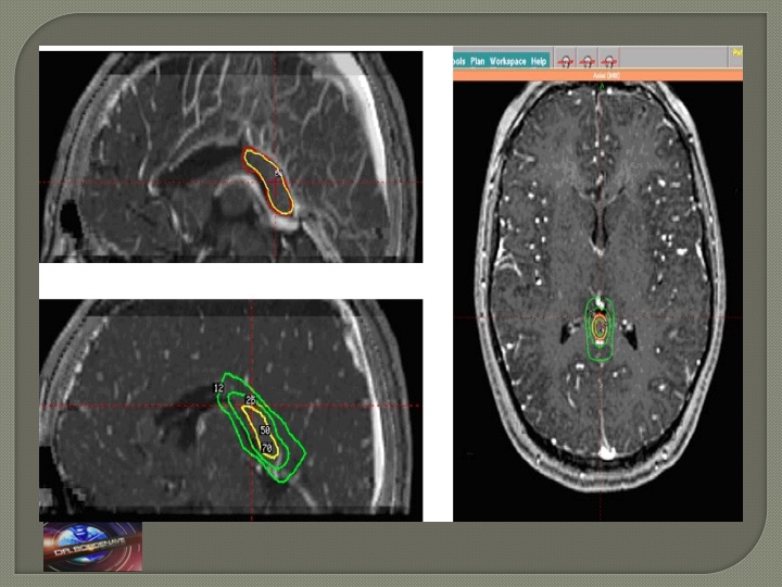 Tamaño del tumor antes y despues de GammaKnife