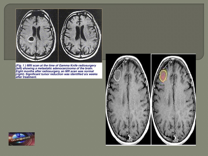 MRI del cerebro al momento del procedimiento muestra lesion cancerosa y 8 meses despues la lesion desaparecio