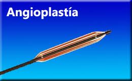 ¿Que es una Angioplastia?